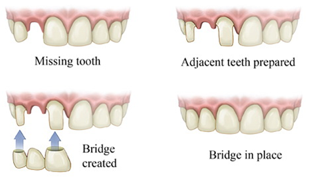 DENTAL BRIDGES 1 DENTAL BRIDGES