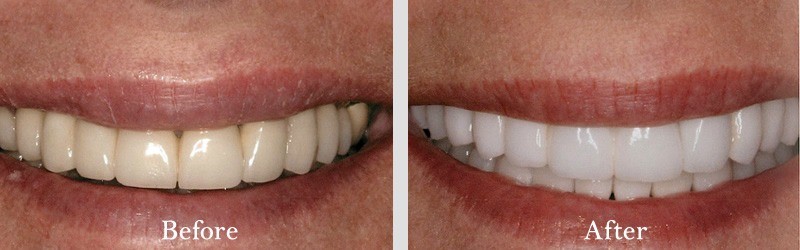 Veneers to fix worn and chipped