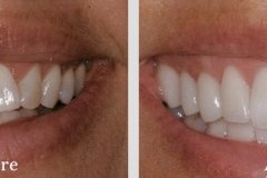 Before & After Dental Photo Gallery | The Silverstrom Group NJ