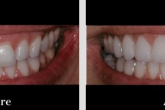 Before & After Dental Photo Gallery | The Silverstrom Group NJ