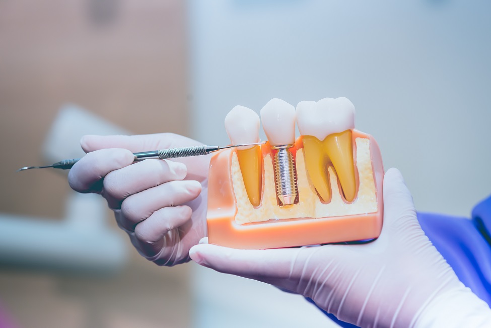 Dental Implant Procedure – What to Expect