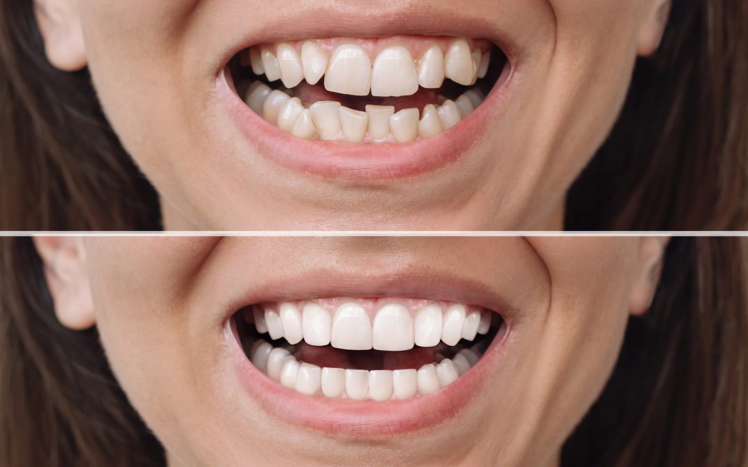 smile makeover in Short Hills